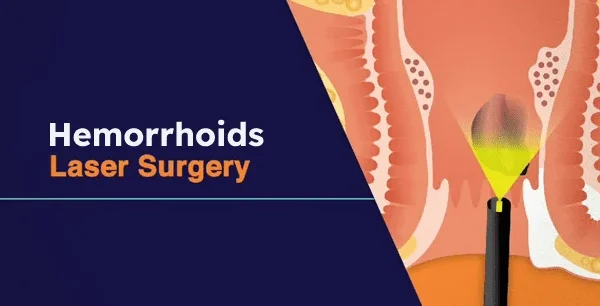 Recovery results of hemorrhoid treatment with laser in Tehran Recovery results of hemorrhoid treatment with laser in Tehran