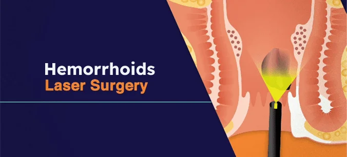 Recovery results of hemorrhoid treatment with laser in Tehran